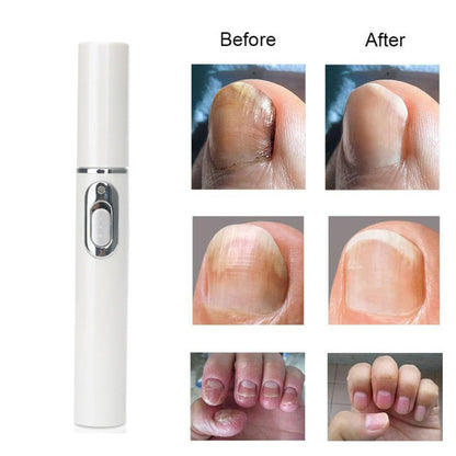 Convenient Nail Fungus Eradication Pen - Painless and Safe Treatment Solution