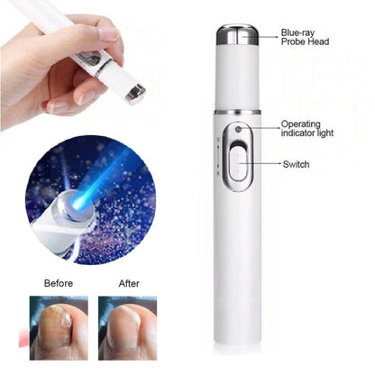 Portable Nail Fungus Laser Pen - Effective Treatment for NailsNail CareNormanharvey