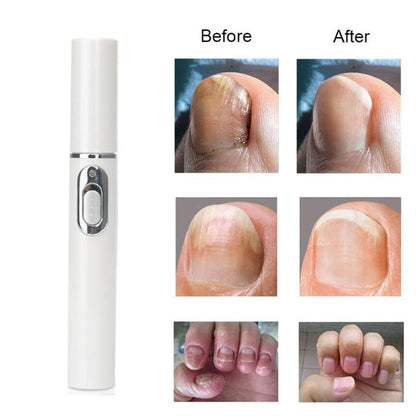 Portable Nail Fungus Laser Pen - Effective Treatment for NailsNail CareNormanharvey